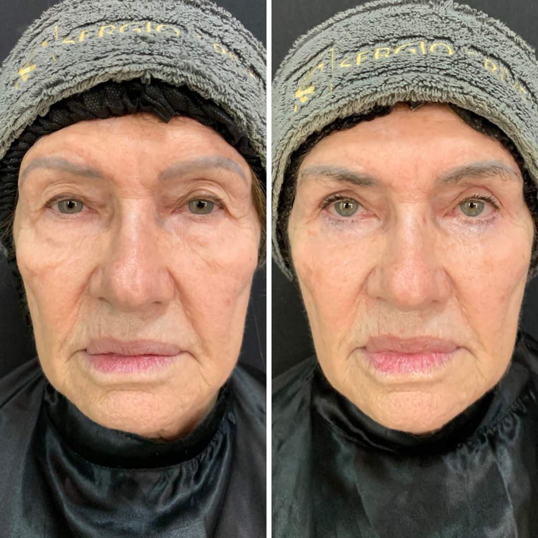 Cópia de Cópia de Before after minimal skincare Instagram post